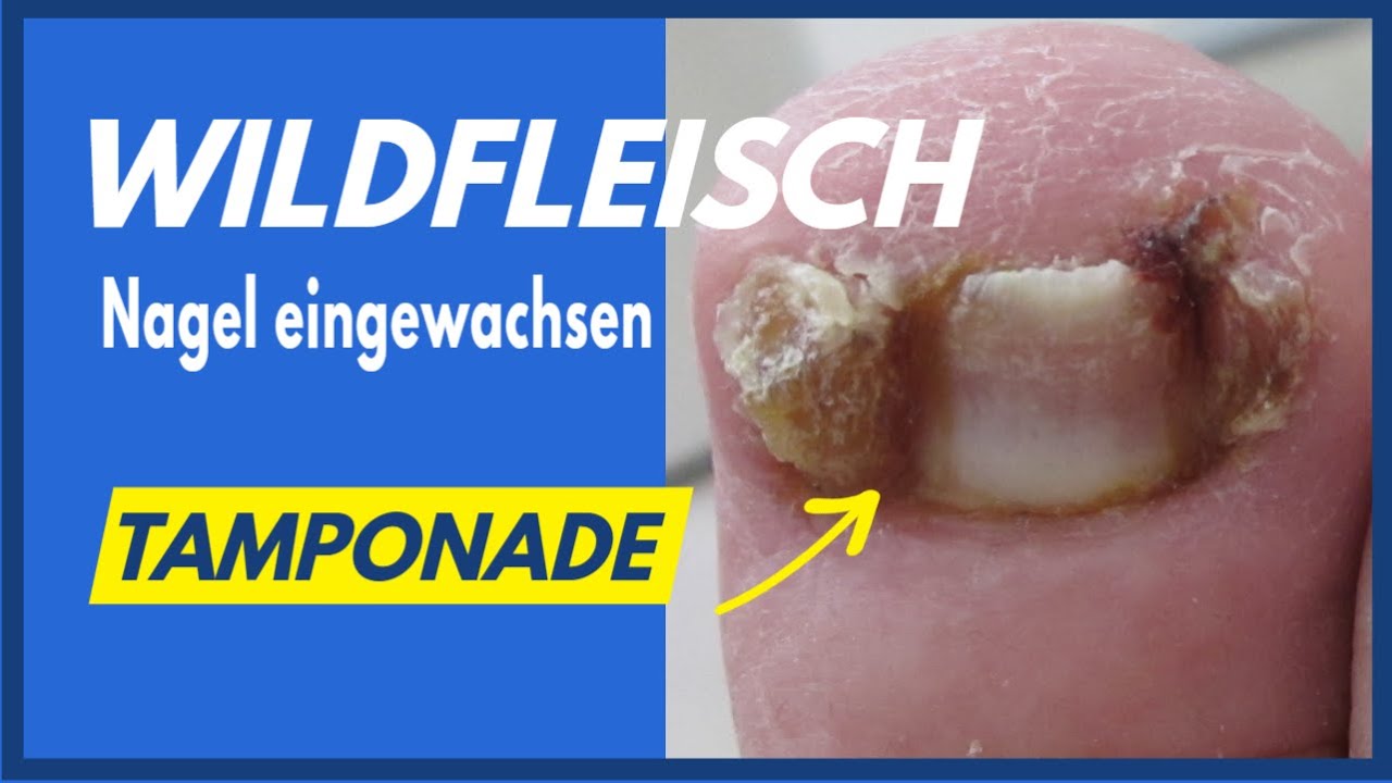 Wildes Fleisch Zeh Ohne Op www.youtube.com