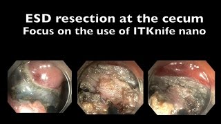 ESD at the cecum with ITKnife nano
