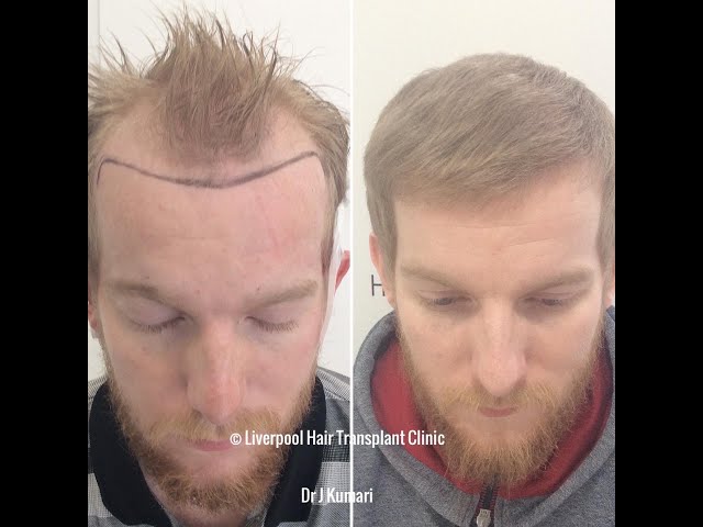 Just after 6 Months Results! Hair Transplant UK