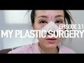 EP 3.1| Revision rhinoplasty & Incision Double Eyelid with Ptosis correction