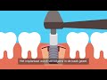 Een implantaat zetten bij de tandarts