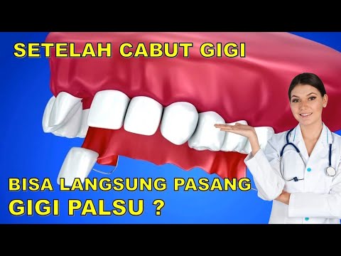 Video: Mengapa gigi palsu dilapisi ulang?