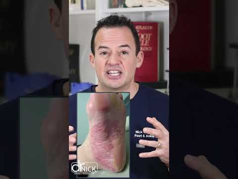Video: Is voetschimmel ringworm?