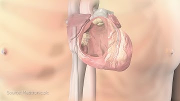 Smallest pacemaker in the world