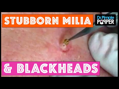 Stubborn Milia Extractions With Dr Pimple Popper