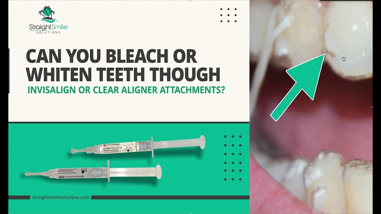 Can you Bleach or Whiten teeth THROUGH Invisalign or Clear Aligner