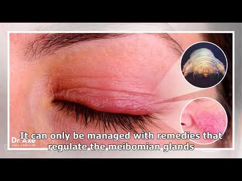 Get Rid of Blepharitis: 7 Natural Remedies for an Inflamed Eyelid