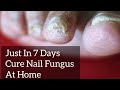 Just In 7 Days Cure Nail Fungus At Home || HOME REMEDY KANNADA || Tips In Kannada ||