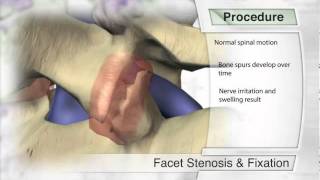 Facet Stenosis & Fixation