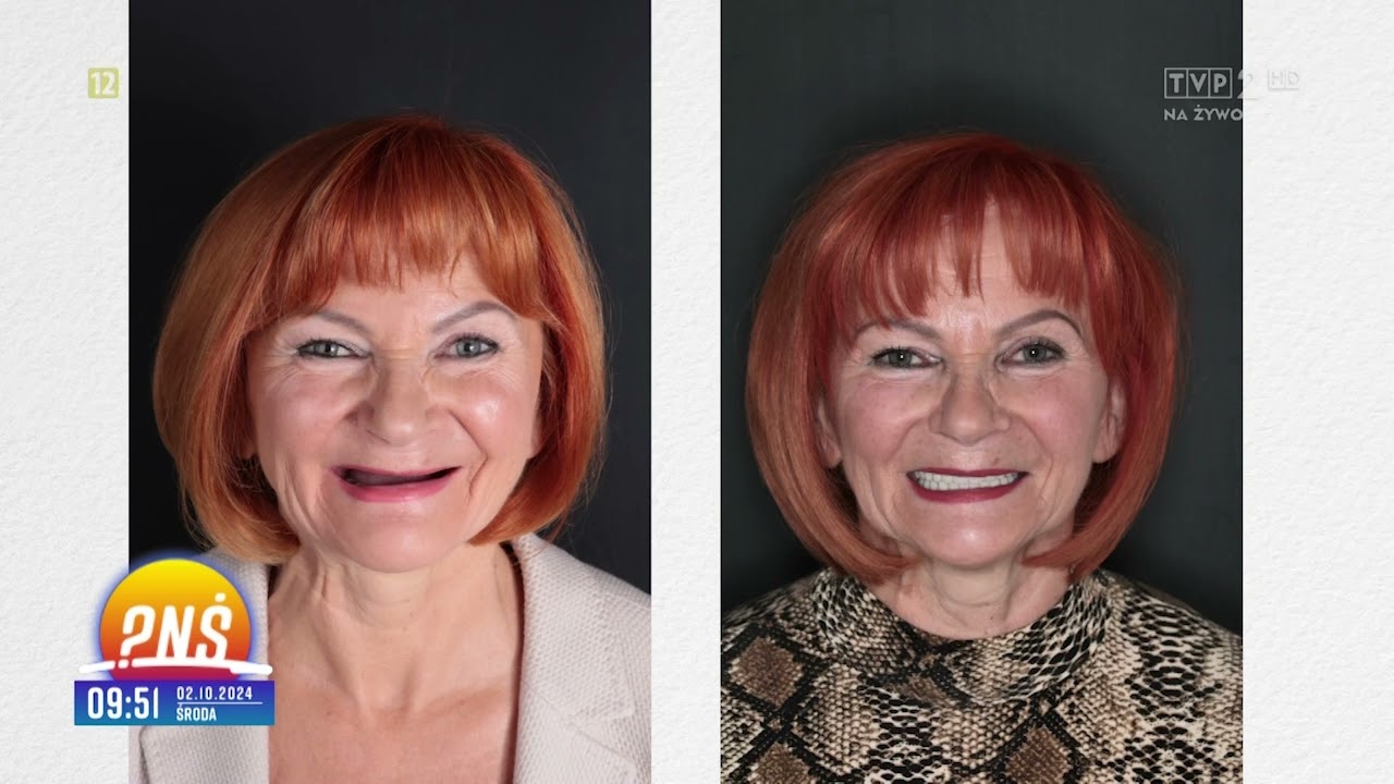 2024-10-02 NIESAMOWITA METAMORFOZA PANI ANTONINY | TRZECIE ZĘBY NA IMPLANTACH W JEDEN DZIEŃ!