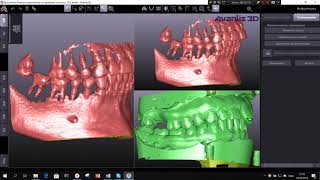 Обучающее видео от Avantis3D -  Виртуальный пациент: совмещение screenshot 1