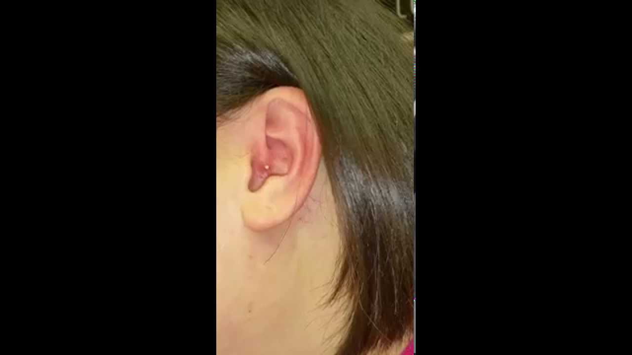 Popping pimple in ear! YouTube