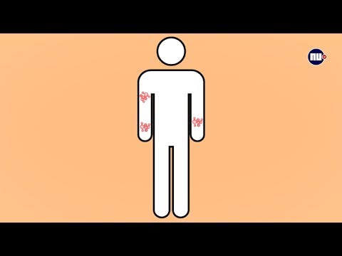 Video: Hoe Weet Ik Of Ik Kanker Van Het Gezicht Heb?