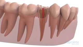 Root canal - Lapointe dental centres