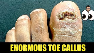 SHAVING OF ENORMOUS NAIL BED CALLUS !