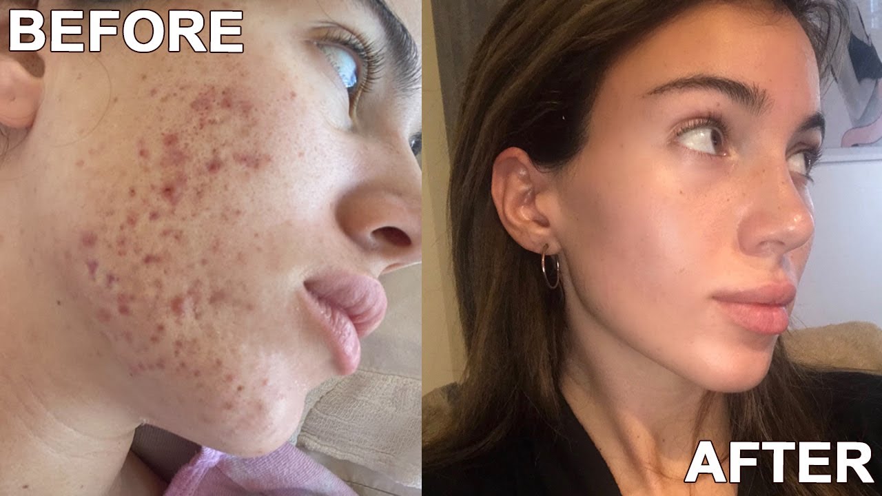 HOW I CLEARED MY SKIN IN 1 MONTH *naturally* | SKINCARE ROUTINE 2021 ...