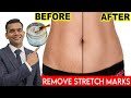1 Best Remedy To Remove Stretch Marks | How To Remove Stretch Marks - Dr. Vivek Joshi