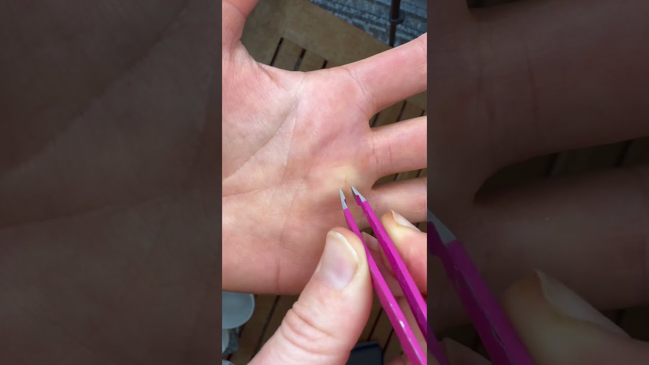 How To Get A Splinter Out When Tweezers Don T Work Carpentry Diy Hack