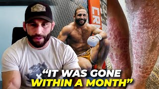 How Chad Mendes Healed Psoriasis Naturally
