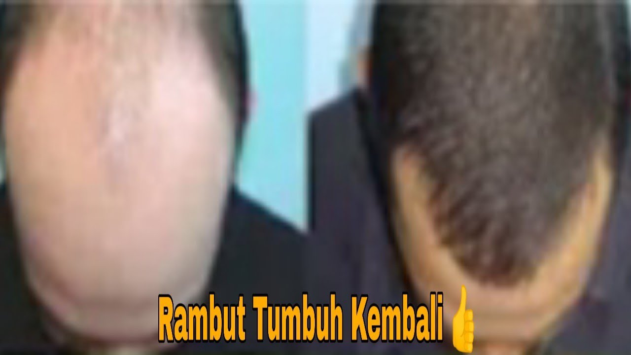 CARA MENUMBUHKAN RAMBUT BOTAK DENGAN CEPAT MUDAH DAN MURAH