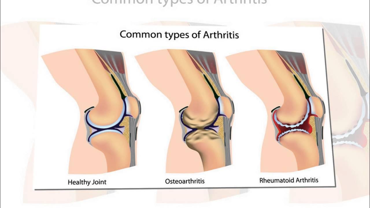 Диета при деформирующем артрозе коленного сустава. Сколько времени лечить сустав. Сколько времени лечить сустав. Коленный сустав. Диагноз гонартроз 1 степени коленного сустава.