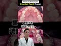 歯が多い方も稀にいらっしゃいます🦷#歯列矯正 #歯医者 #dentist #ワイヤー矯正 #蒲田 #歯