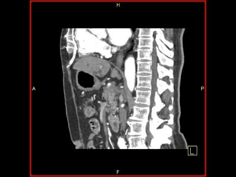 Abdomen: Pancreas: Pancreatic cancer invades portal vein:Sagittal perspective of vessel enasement