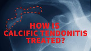 How is calcific tendonitis treated?