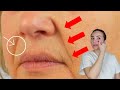 Effective techniques for those nasolabial folds  massive nasolabial folds