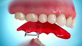 Removable Bite Plate