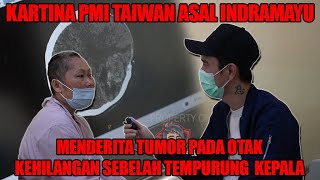 Kartina PMI Taiwan asal Majalengka harus kehilangan separuh bgian tempurung kepala karena tumor otak