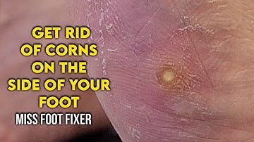 How to Get Rid of Corns on the Side of Your Foot  By  Foot Specialist Miss Foot Fixer
