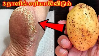 பாத வெடிப்பு குதி கால் வலி சரியாகி மென்மையாகிவிடும் |eliminate cracked heel and pain get smooth feet screenshot 2