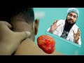 Big Lipoma Tumor Operation || ঘাড়ে টিউমারটি হয়েছিল ৮ বছর যাবৎ