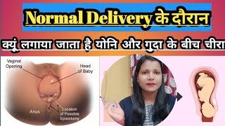 क्या होता है Episiotomy  Normal Delivery के समय क्यूं लगाया जाता है योनि मे चीरा 