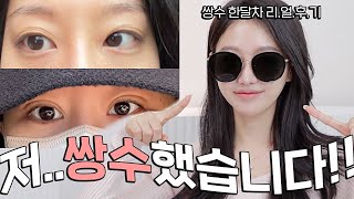 100% Candid result of doubleeyelid surgery A month after review!! ㅣ INBORA