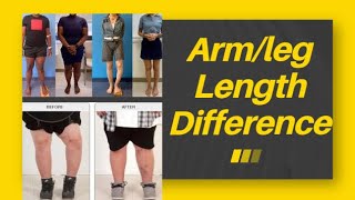 Armleg Length Difference Distalproximal Limb Deficiency Polydactyly