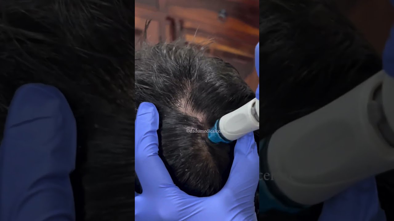 Best Treatment For Dandruff Keravive HydraFacial
