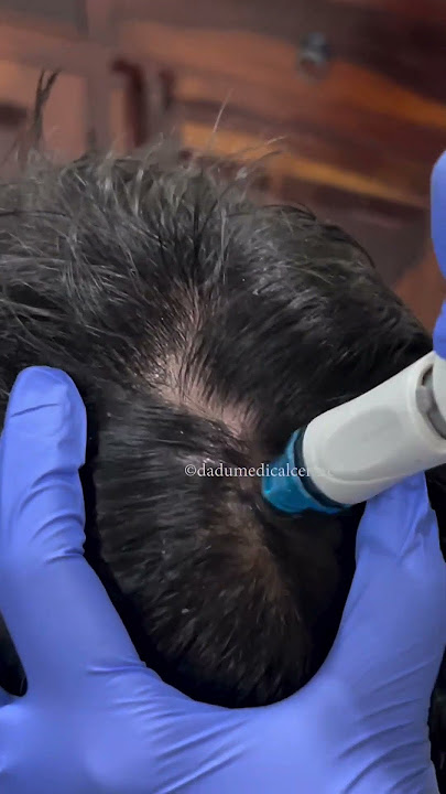 Best Treatment for Dandruff | Keravive HydraFacial