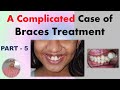 A Complicated case of Braces treatment - Part 5