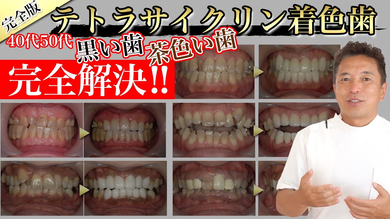 テトラサイクリン 歯 芸能人