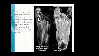 Diabetic Foot Mri Examination