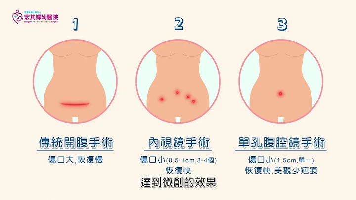 宏其婦科微創手術中心簡介│內視鏡手術、單孔腹腔鏡手術 - 天天要聞