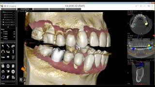 Carestream CS 3D Imaging Implant Workflows | Streamhealth Dental