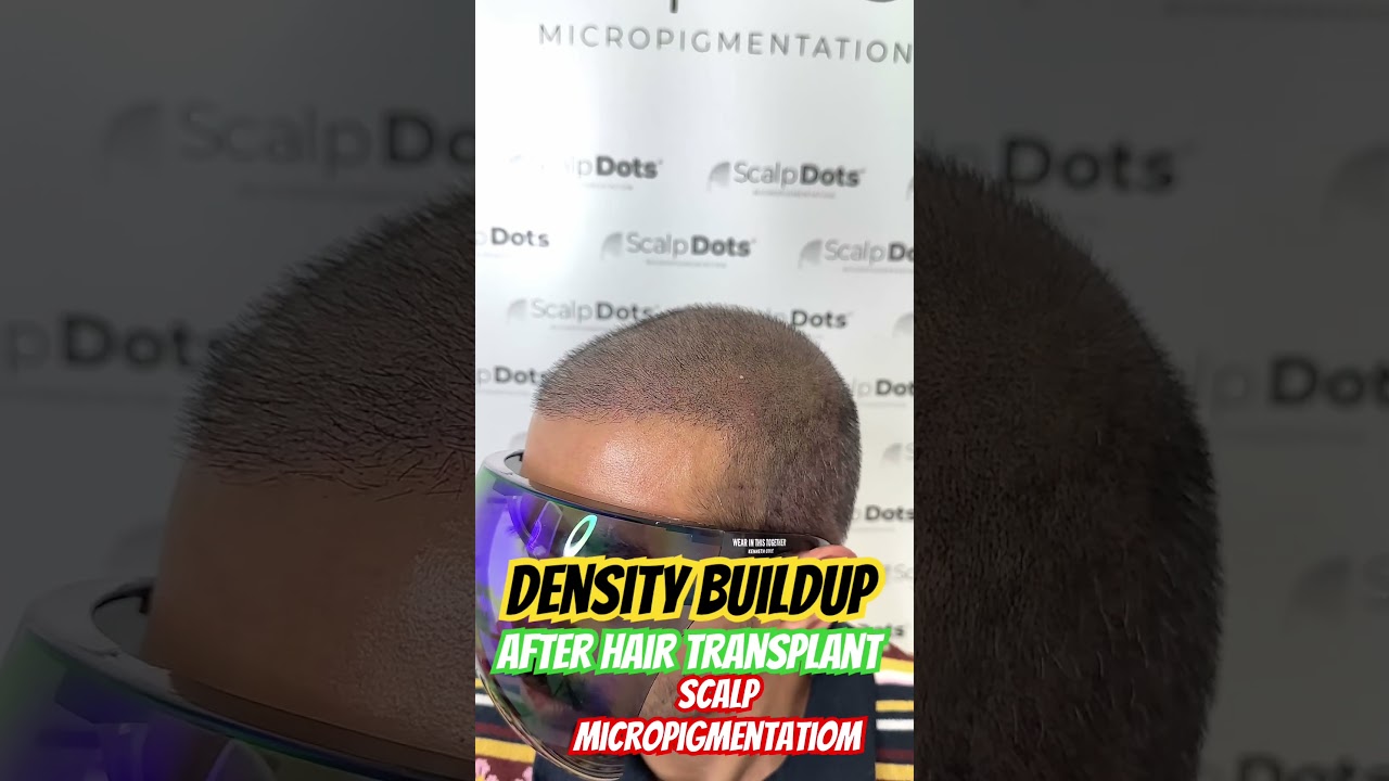 Density filling with scalp micropigmentation after hair transplant 
