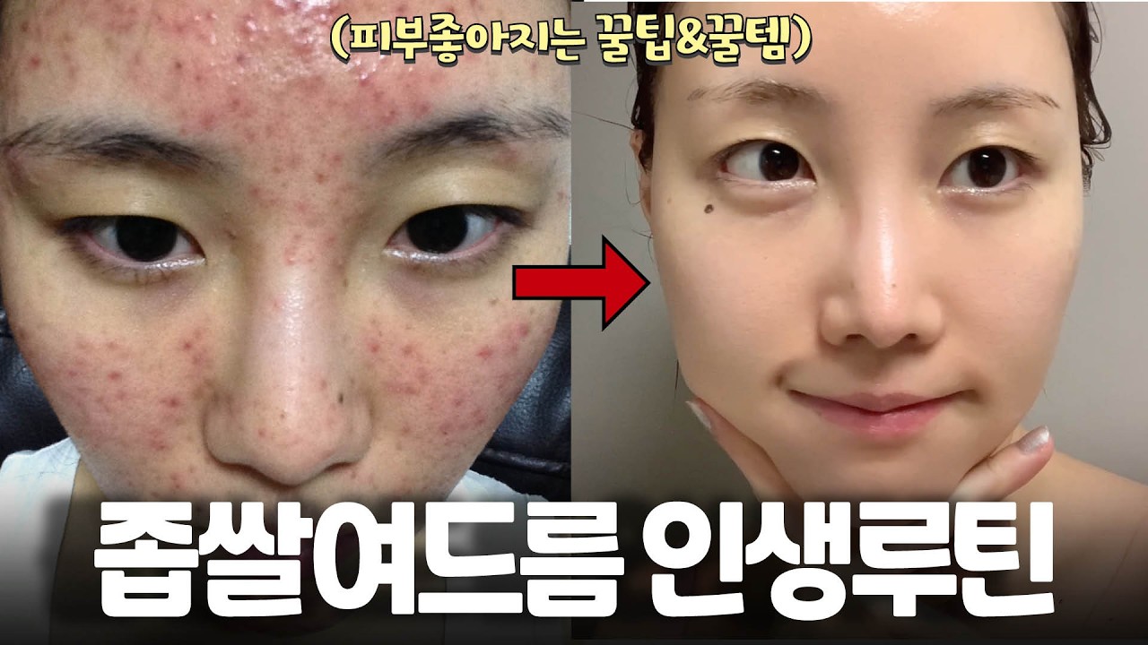 올리브영 세일템💚좁쌀여드름 인생루틴 다 풉니다🔥(여드름/피지/ 모공) 파워지성, 수부지 다 드루와 ✔️피부 좋아지는 법 ✚수분광