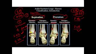 Lauge Hansen Ankle Fracture Classification