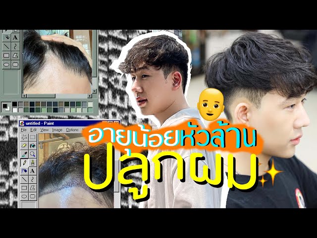 รีวิวปลูกผม 2021 - ผมขึ้นจริงหรือหลอกหลวง คิดดีแล้วหรอจะปลูกผม? | FUE hair transpant