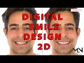 Digital smile design  2d