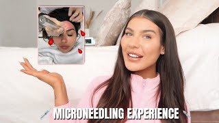 MICRONEEDLING EXPERIENCE - How does it work Does it hurt Is it worth it